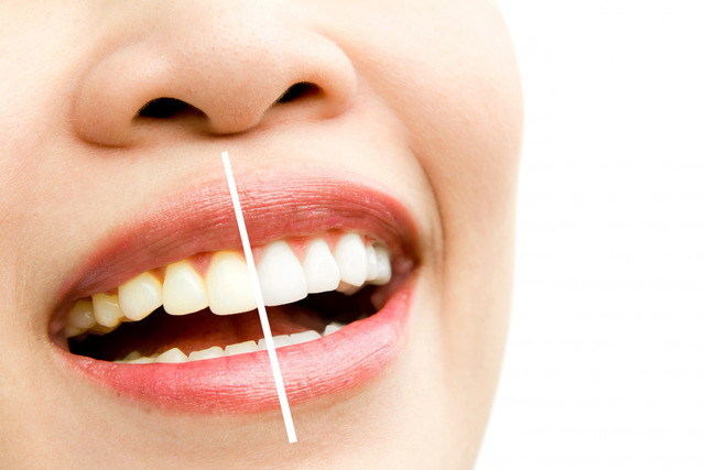Zoom-Whitening